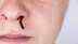 Why your nose bleeds when you sneeze and how to stop it: Common causes, risks and treatment