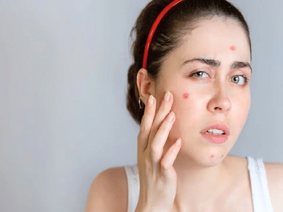 Period Acne Alert: Getting Pimples Before Every Period? These 5 Reasons ...