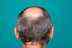 Men across India are going bald - but researchers say the real reason may shock you