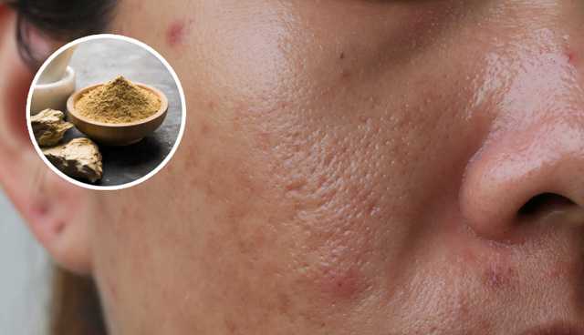 5 DIY Ways To Use Mutani Mitti for Oily Skin
