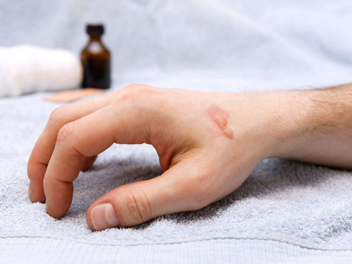 How To Cover A Burn Blister With Makeup Mugeek Vidalondon